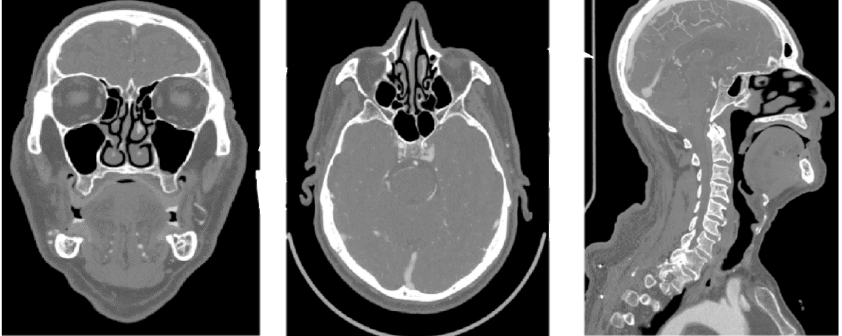 CT Scans